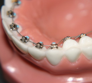 Виды брекетов в стоматологии