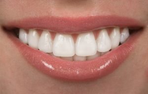 Восстановили зубы с помощью виниров. Что делать?