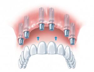 Восстановление утраченных зубов с помощью имплантации