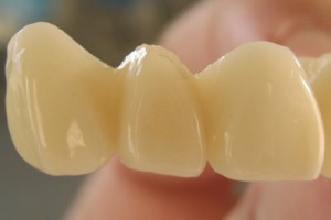 Временные коронки на зубы