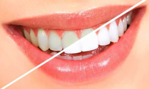 Преимущества фторирования зубов