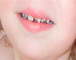 Профилактика заболеваний молочных зубов