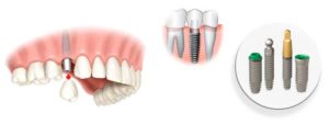 Имплантация - третья жизнь зубов