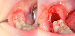 Последствия удаления зубов мудрости. Какие они?