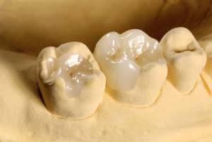Зубная вкладка - последняя жизнь зуба