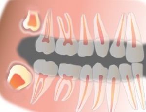 Зубы мудрости в стоматологии