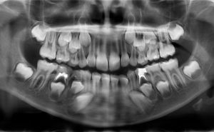 Зачем делать рентген зубов у ребенка?