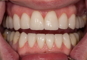 Реставрация зубов с помощью виниров